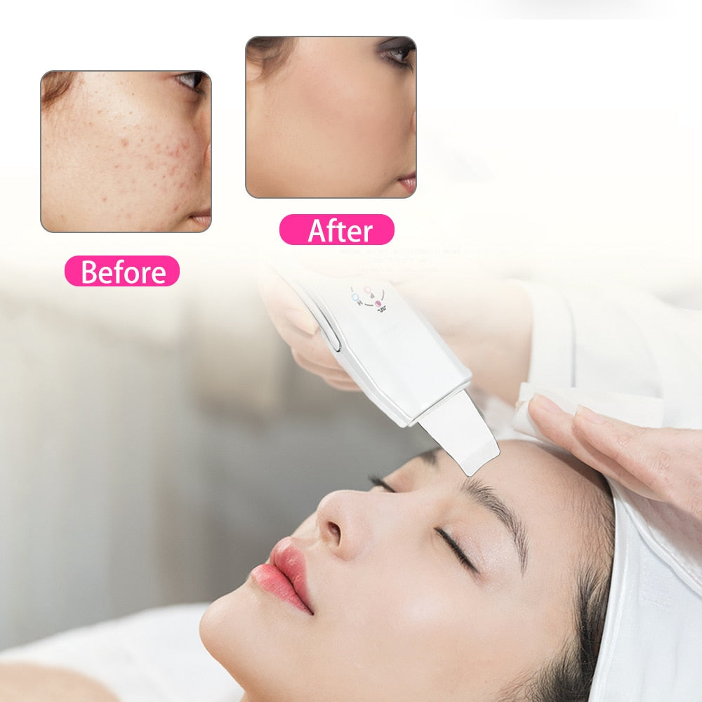 Beauty Star Ultrasonic Skin Scrubber Massager Machine Facial Skin Cleaning