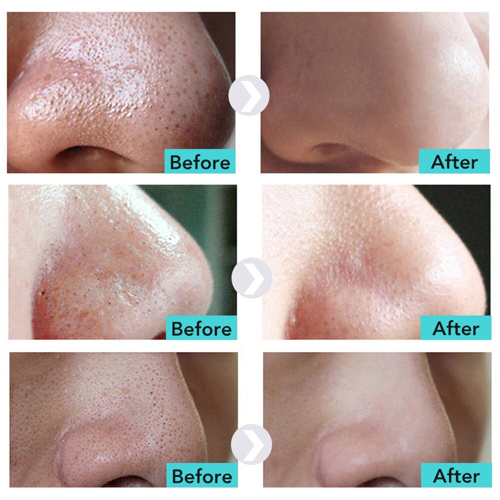 Beauty Product The Best Of You Acne Scar Removal Cream